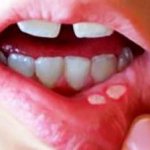 viral stomatitis in children how long does it last