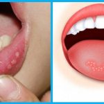 Вирусный стоматит