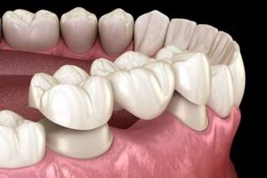 Внезапная неприятность: что делать, если с зуба отвалилась коронка? Срочные меры
