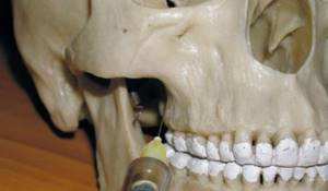 Внутрикостная анестезия зубов