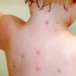 Водянистые прыщи на теле