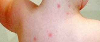 Watery acne on the body