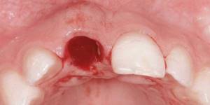 Воспаление десны после удаления зуба
