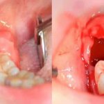 Воспаление в лунке