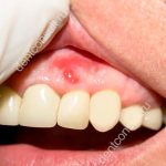 inflammation of the periosteum of the tooth