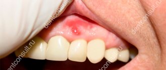 воспаления надкостницы зуба