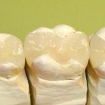 Восстановление жевательного зуба керамической вкладкой
