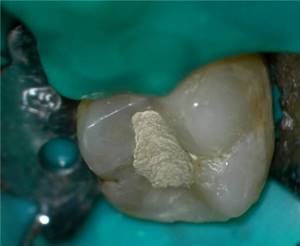 Временная пломба в зубе