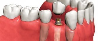 Loss of dental crown