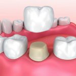 выпала коронка со штифтом что делать