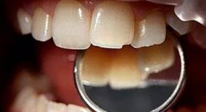Вывих зуба – симптомы и лечение, фото и видео.