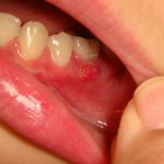 Язвы на деснах