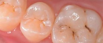 заболевание зубов