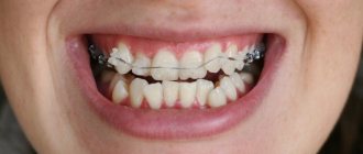 Зачем нужно удалять зубы перед установкой брекетов