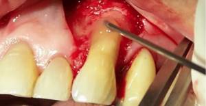 Зачем стоматологу скальпель: лоскутная операция при пародонтите