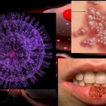 Herpes infection