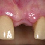 заживление лунки