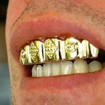 Gold denture for teeth