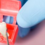 зуб мудрости симптомы появления