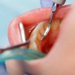 Зубная бляшка: состав, причины и этапы образования - советы и рекомендации о здоровье на AllMedNews.ru