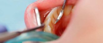 Dental plaque: composition, causes and stages of formation - tips and recommendations about health on AllMedNews.ru