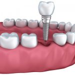 Зубной имплантат