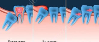 зубы мудрости
