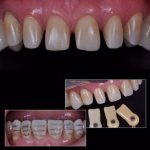 зубы после обточки под виниры