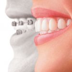 Зубы с неправильным прикусом