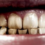 Зубы становятся прозрачными: причины, способы лечения, что делать?
