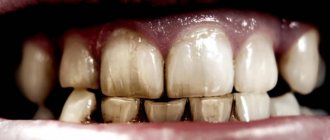 Teeth become transparent: causes, treatment methods, what to do?